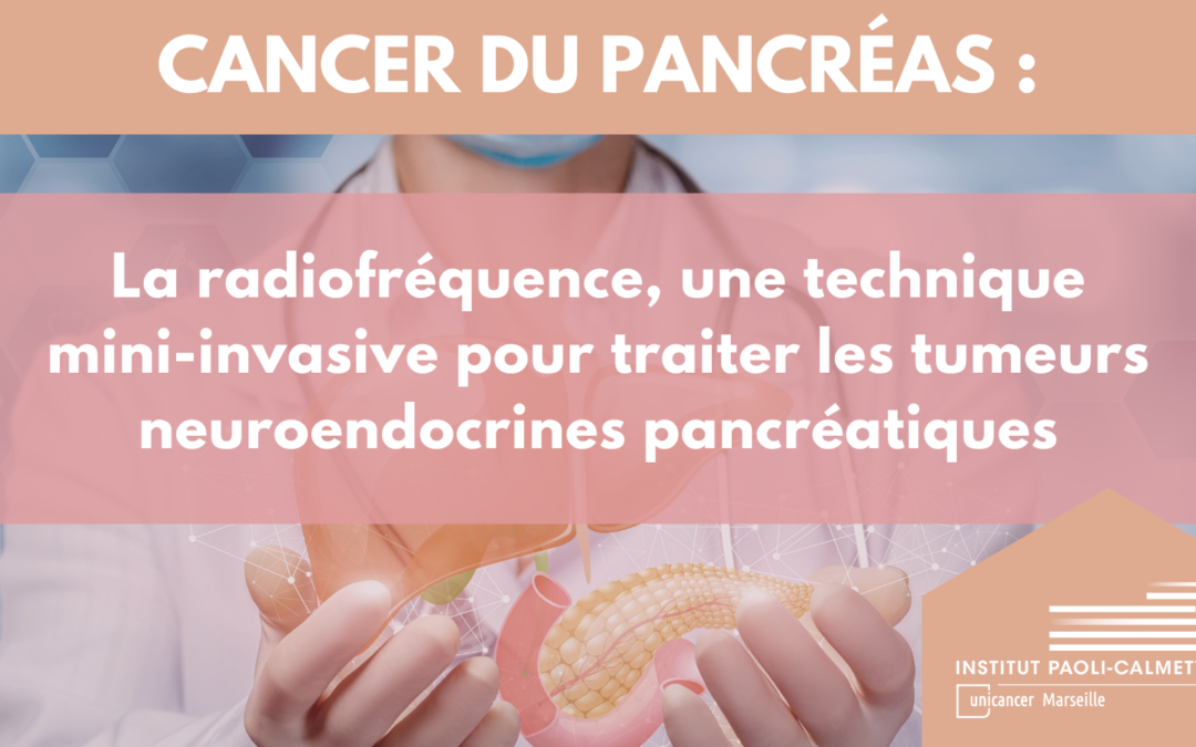 La radiofréquence, une technique mini-invasive pour traiter les tumeurs neuroendocrines pancréatiques